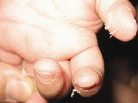 Nguyên nhân xước măng rô ở ngón tay